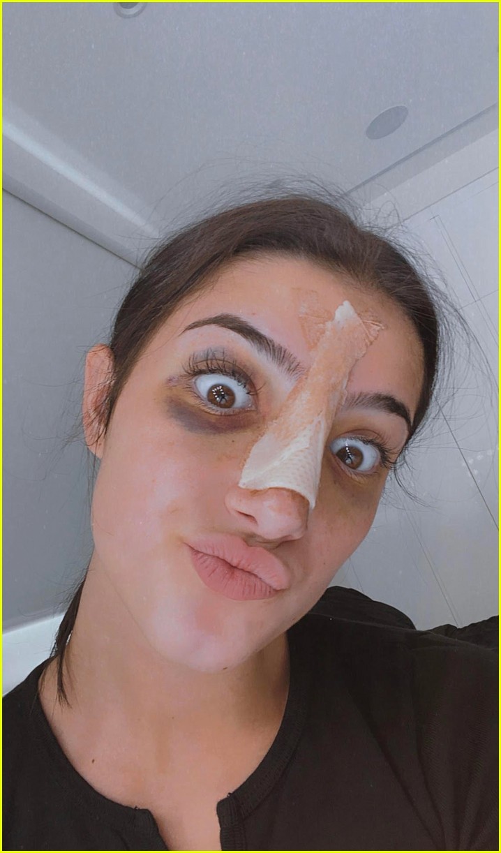 charli damelio shares new photos post nose surgery 01
