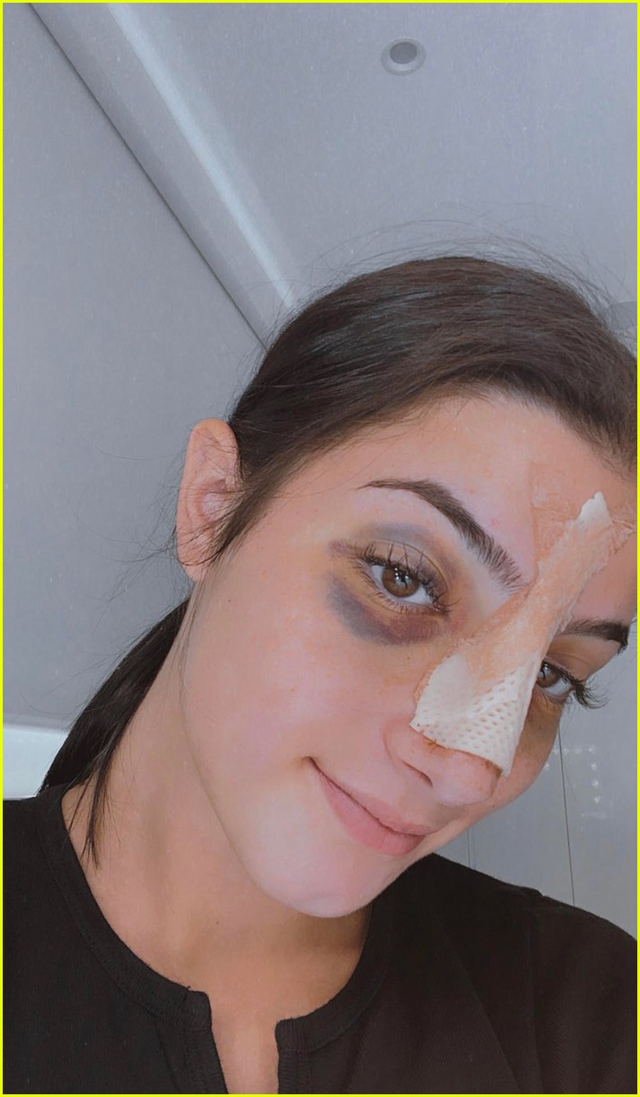 charli damelio shares new photos post nose surgery 02