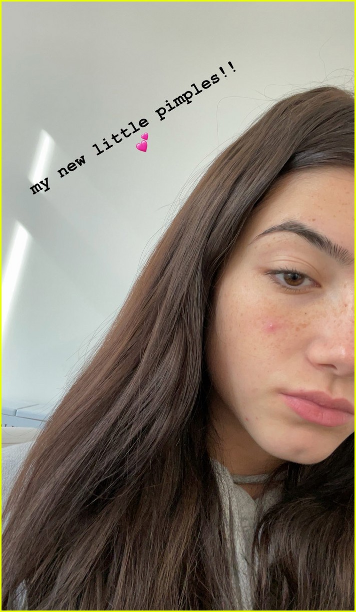 charli damelio opens up about acne i am a teenager 01