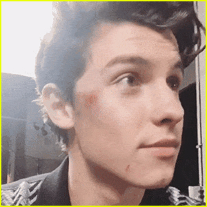 Shawn Mendes Shows Off Face Bruise on Instagram Stories - Here's How He Got It